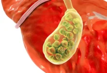 Gallbladder Removal Singapore After Jaundice or Blocked Bile Duct Symptoms