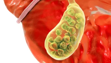 Gallbladder Removal Singapore After Jaundice or Blocked Bile Duct Symptoms