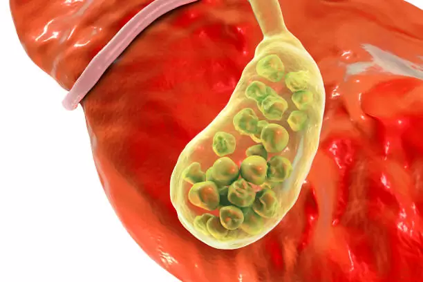Gallbladder Removal Singapore After Jaundice or Blocked Bile Duct Symptoms