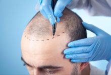 hair-transplant