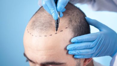 hair-transplant