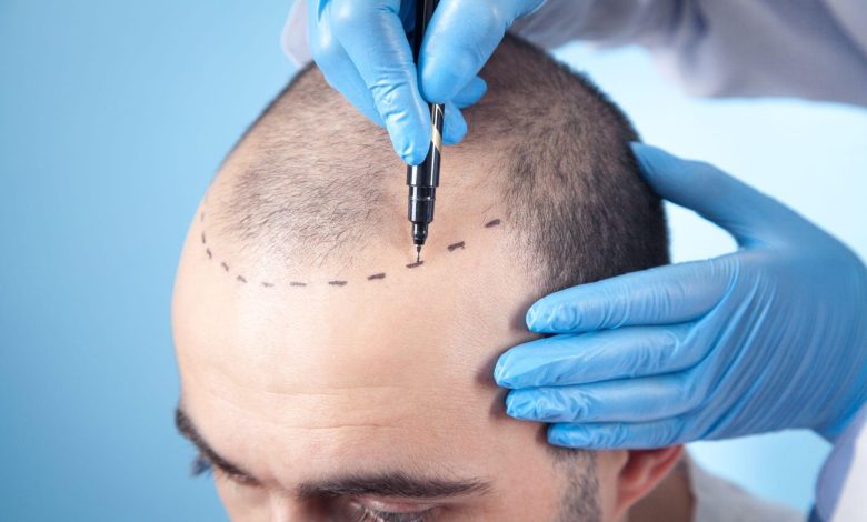 hair-transplant