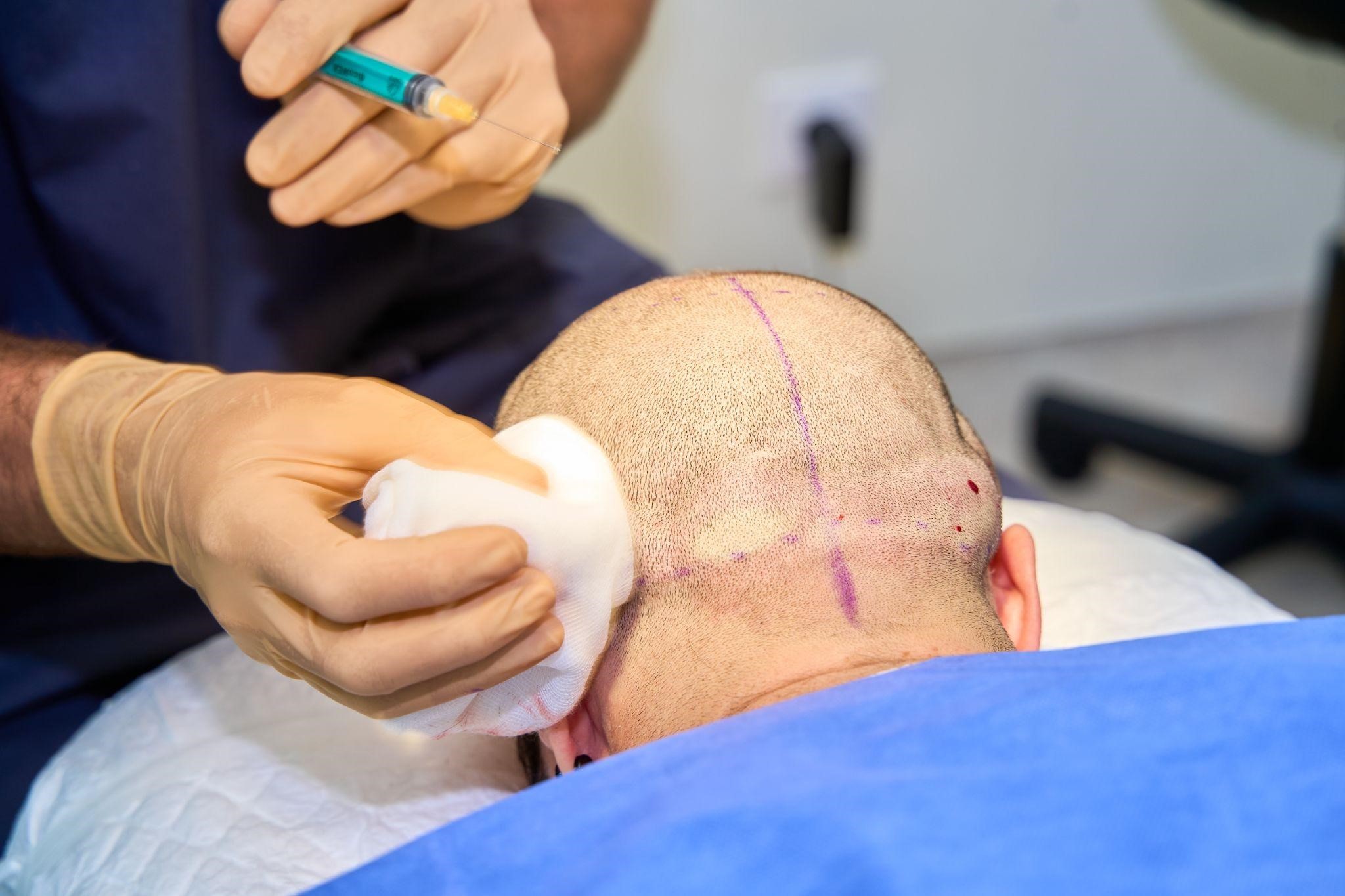 Hair Transplant Technique